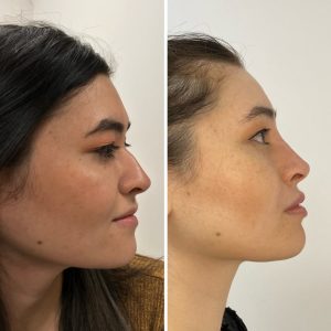 Non-surgical rhinoplasty