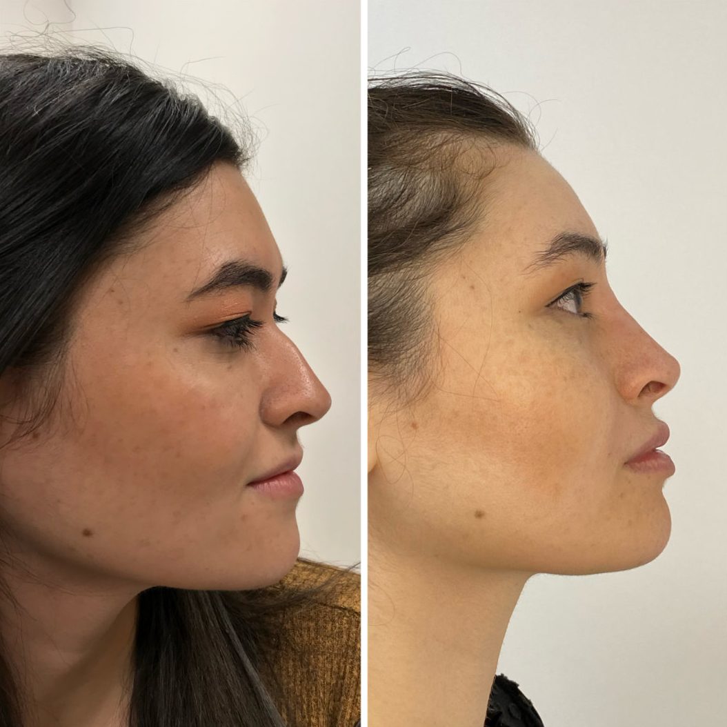 Non-surgical rhinoplasty