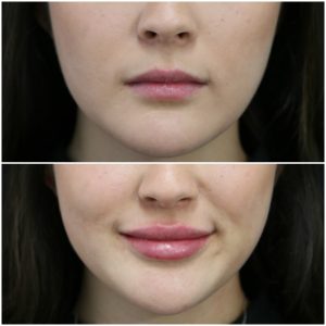 Lip Correction
