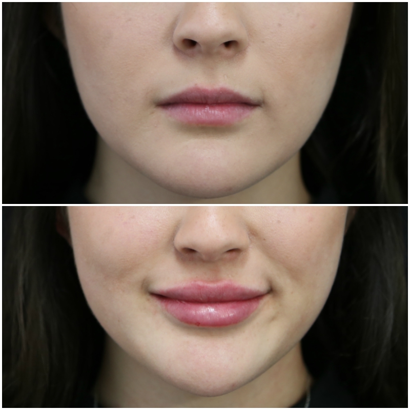 Lip Correction