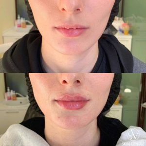 Mesotherapy